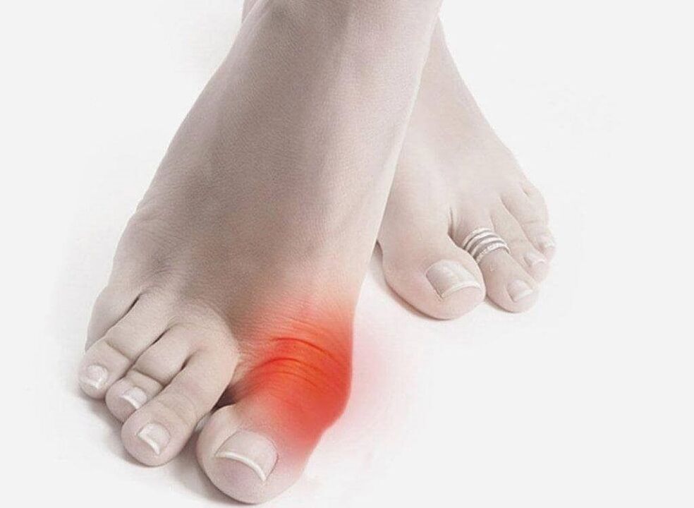 sintomas do pé gota